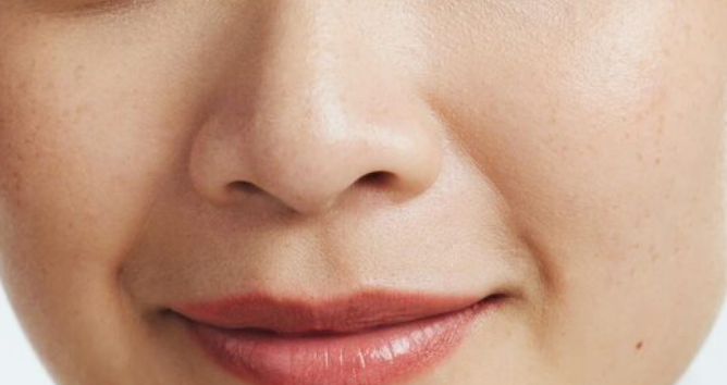 Nasolabial Fold Botox, Thread Lift, and Filler: A Comprehensive Guide to the Differences Between Procedures