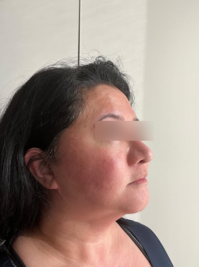 Why More Pull Isn't Always Better for a Facelift at Sinnonhyeon Station Plastic Surgery 사진 7