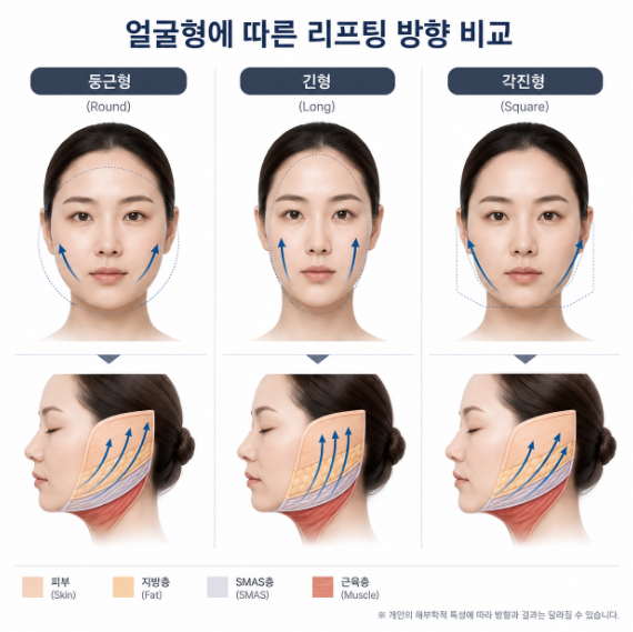 Why More Pull Isn't Always Better for a Facelift at Sinnonhyeon Station Plastic Surgery 사진 9
