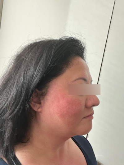 Why More Pull Isn't Always Better for a Facelift at Sinnonhyeon Station Plastic Surgery 사진 6