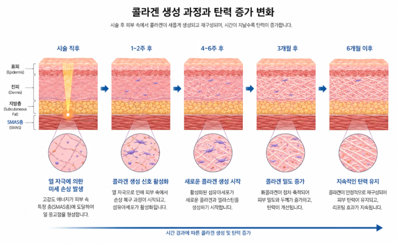 Perbandingan Aptos dan Ultherapy, Poin Kunci Penentu Efek Lifting 사진 6