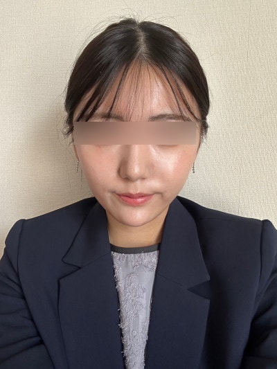 Gangnam Thread Lift Recommendation: Why Choosing the Right Threads for Your Face is Crucial 사진 6