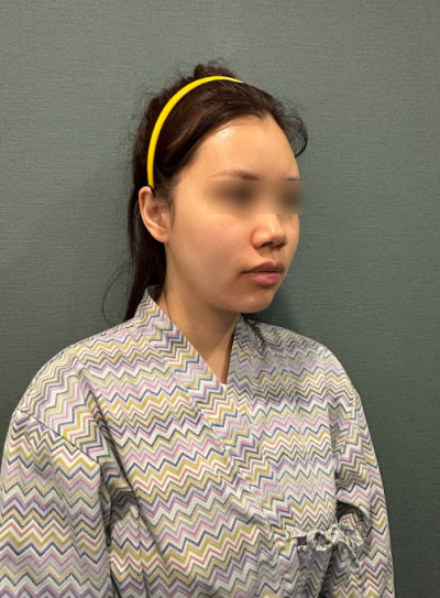 Gangnam Thread Lift Reviews: What Changes Can Be Seen in Before & After Photos? 사진 7