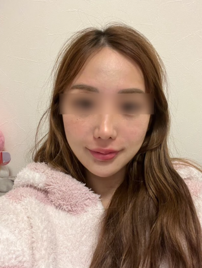 Gangnam Thread Lift Reviews: What Changes Can Be Seen in Before & After Photos? 사진 11