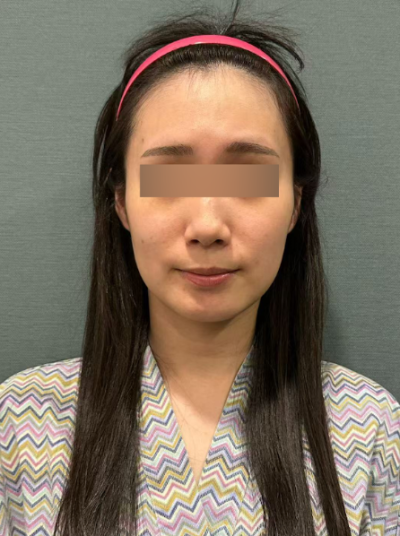 Aptos Thread Lift: Clarifying Common Confusions Before Choosing 사진 5