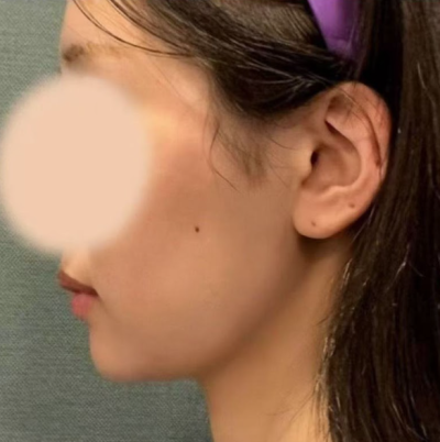 Aptos Thread Lift: Clarifying Common Confusions Before Choosing 사진 8