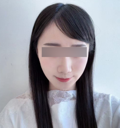 Aptos Thread Lift: Clarifying Common Confusions Before Choosing 사진 6