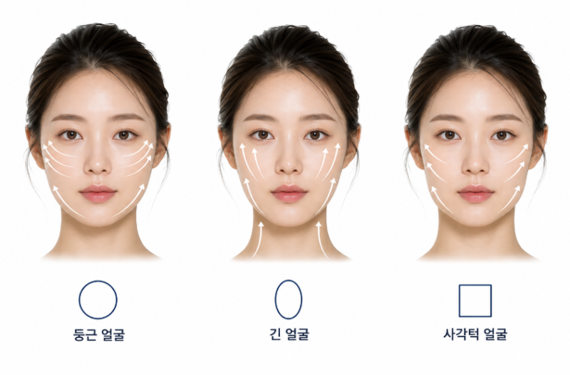 Perbandingan Aptos, Mint Thread, Silhouette Soft, Apa Kriteria Pemilihan Thread Lifting? 사진 7