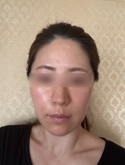Seoul Thread Lift Recommendations: Specific Criteria for Higher Satisfaction 사진 11