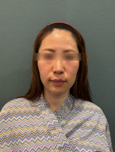 Seoul Thread Lift Recommendations: Specific Criteria for Higher Satisfaction 사진 10