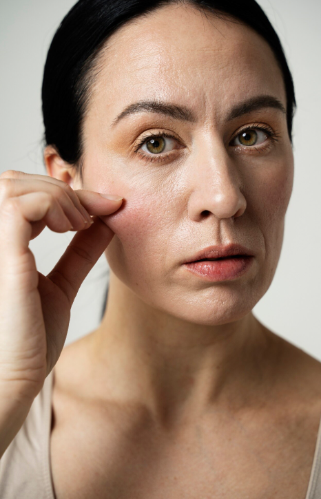 Facelift: The ‘Direction of Pull’ is Crucial for Improving Nasolabial Folds 사진 4