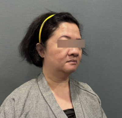 Facelift: The ‘Direction of Pull’ is Crucial for Improving Nasolabial Folds 사진 8