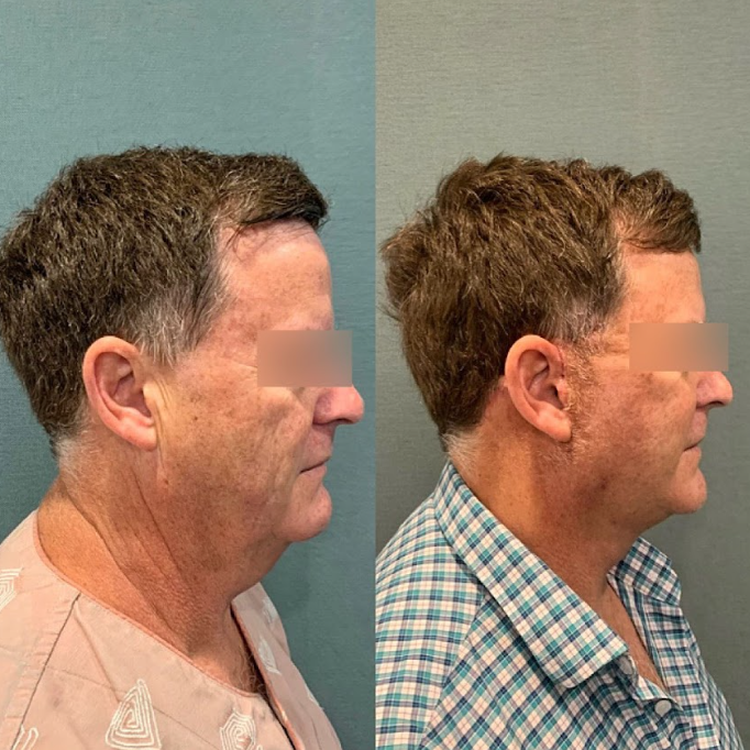 Gangnam Facelift Clinic: The Difference in Lifting for a Defined Jawline 사진 10