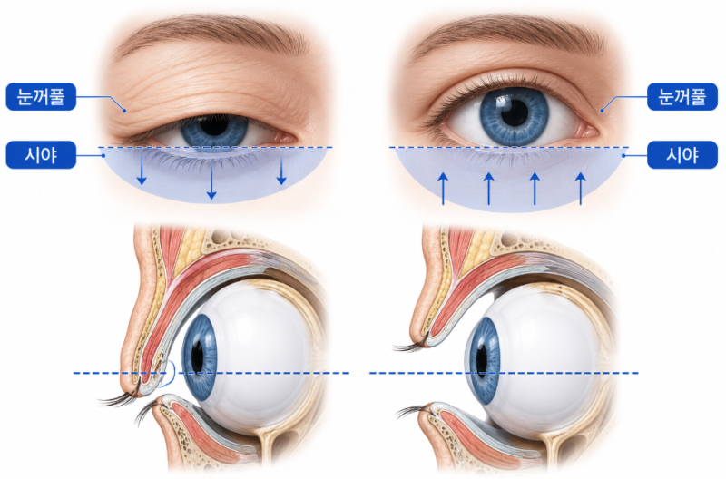 Upper Blepharoplasty: What to Check if Droopy Eyelids Make You Look Older