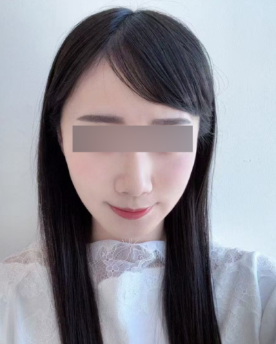 Mint Thread Lift Side Effects: Reasons for Dimples and Sagging, and Recovery Process 사진 9