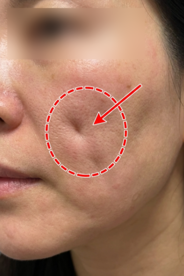 Mint Thread Lift Side Effects: Reasons for Dimples and Sagging, and Recovery Process 사진 3