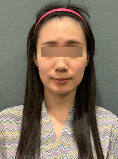 Mint Thread Lift Side Effects: Reasons for Dimples and Sagging, and Recovery Process 사진 8