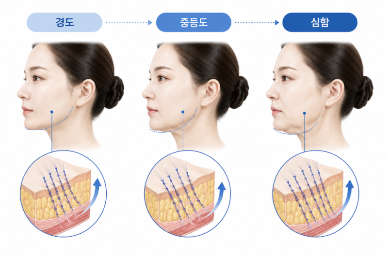 Mint Thread Lift Side Effects: Reasons for Dimples and Sagging, and Recovery Process