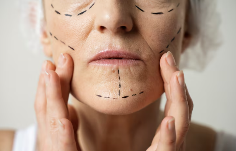 Seoul Jamber Thread Lift: Why the Same Thread Yields Different Results
