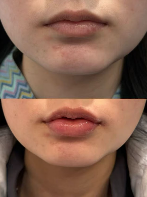 Seoul Plastic Surgery: The Reason Your Vibe Changes with Just Lip Fillers 사진 8