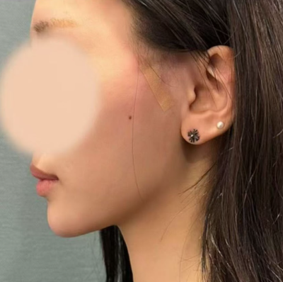 Gangnam Thread Lift Reviews: What Made Them So Satisfied? 사진 7