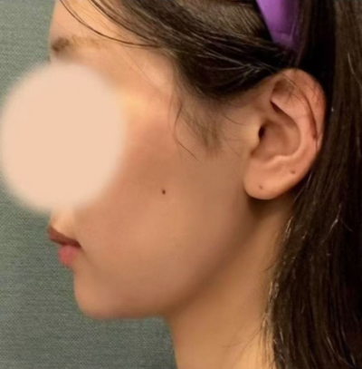 Gangnam Thread Lift Reviews: What Made Them So Satisfied? 사진 6