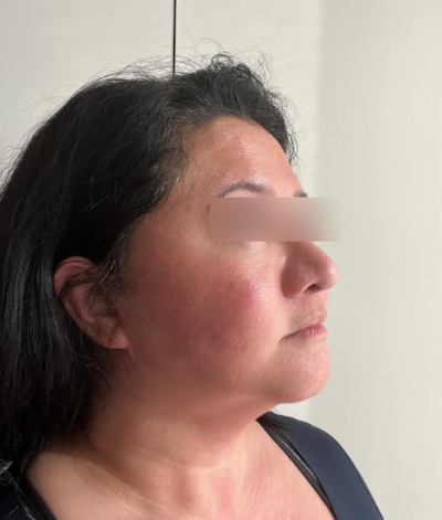 Facelift Gangnam, Apa Perbedaan Hasil yang Bertahan Lama? 사진 9