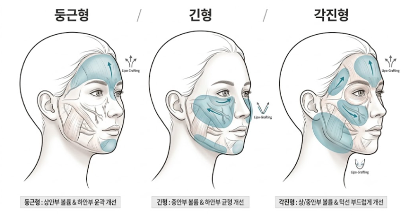 Gangnam Station Plastic Surgery: What are the criteria for increasing the engraftment rate of facial fat grafting? 사진 8
