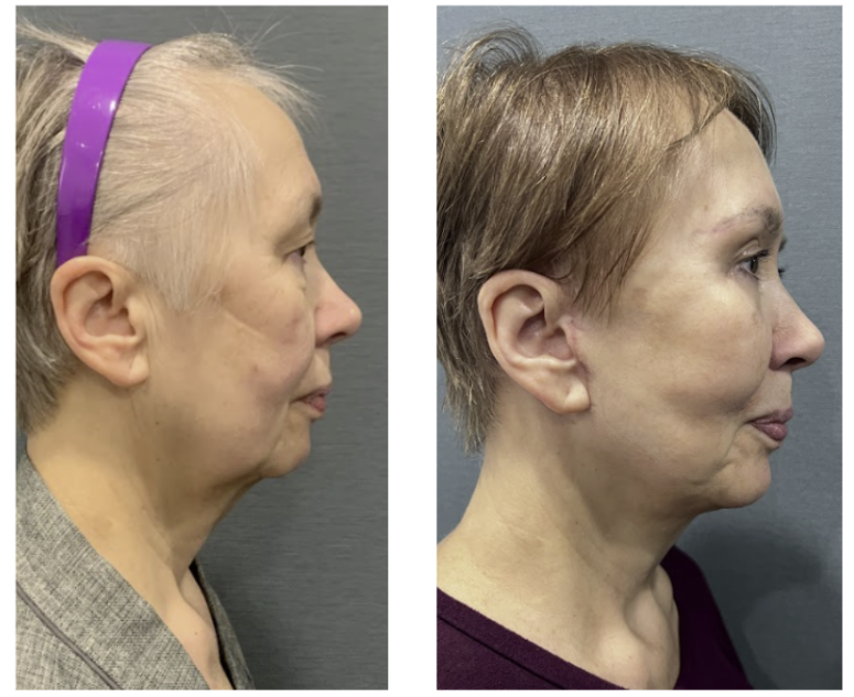 Apgujeong Plastic Surgery Facelift: Understanding the Process Makes Your Choice Easier 사진 6