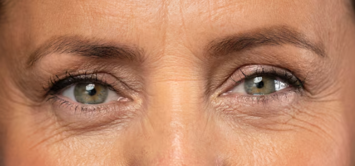 Nonhyeon Plastic Surgery: When Should You Consider Under-Eye Fat Repositioning? 사진 6