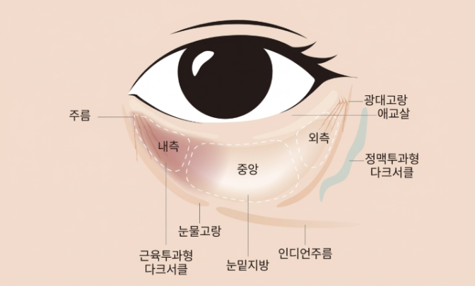 Nonhyeon Plastic Surgery: When Should You Consider Under-Eye Fat Repositioning? 사진 3