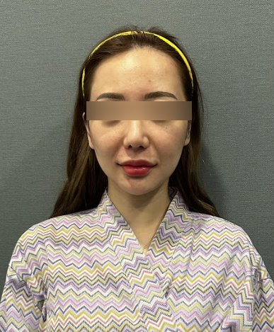 Gangnam Plastic Surgery Clinic: Thread Lift – Knowing This Before Your Procedure Makes Choosing Easier 사진 9