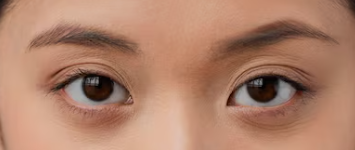What's the Difference Between Under-Eye Fat Removal and Under-Eye Fat Repositioning? 사진 8