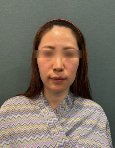 Gangnam Nasolabial Fold Lifting: When is Lifting More Necessary Than Filler? 사진 9