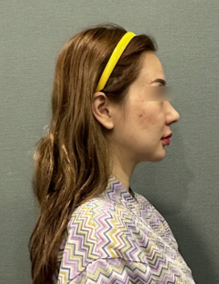 Gangnam Nasolabial Fold Lifting: When is Lifting More Necessary Than Filler? 사진 7