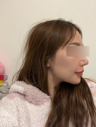 Gangnam Nasolabial Fold Lifting: When is Lifting More Necessary Than Filler? 사진 8