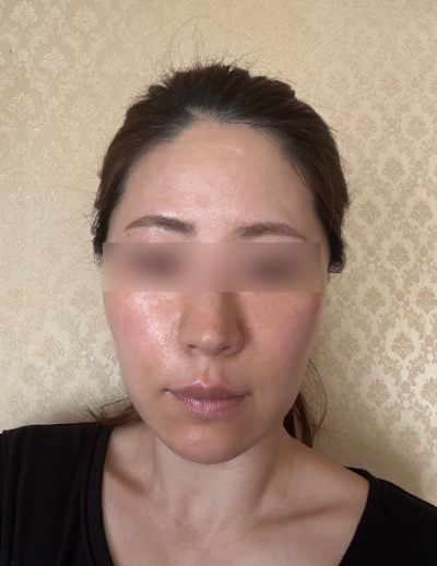 Gangnam Nasolabial Fold Lifting: When is Lifting More Necessary Than Filler? 사진 10