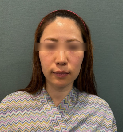 서울 얼굴주름리프팅, 나이보다 어려 보이는 비결은 무엇일까요? 사진 4