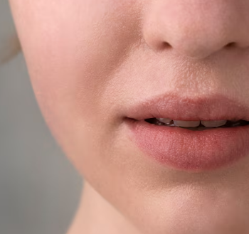 Nasolabial Fold Filler: 3 Essential Checks Before Getting It 사진 3