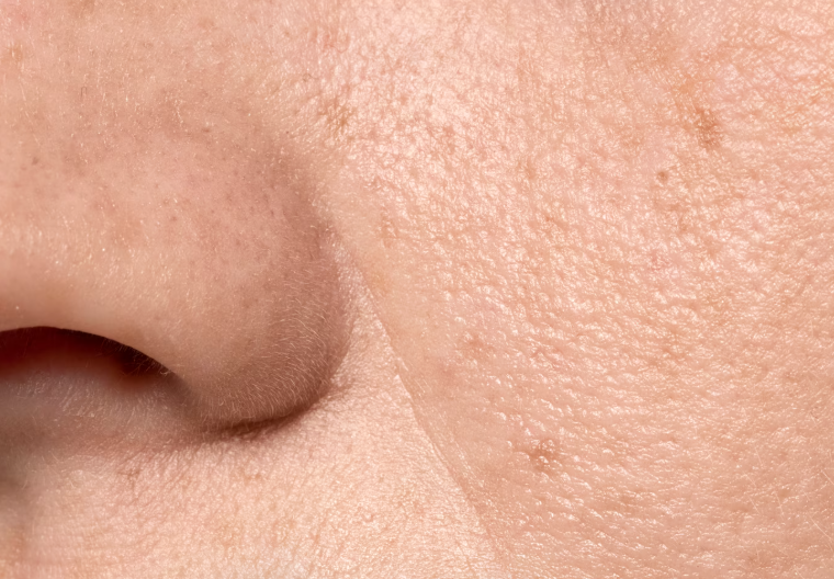 Nasolabial Fold Botox: Understand the Difference from Fillers First 사진 7