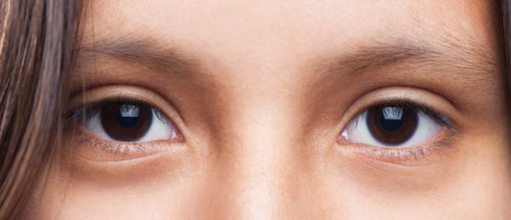 Gangnam Lower Blepharoplasty: If Your Undereyes Look Aged, Check This First 사진 2