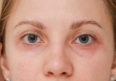 Gangnam Lower Blepharoplasty: If Your Undereyes Look Aged, Check This First 사진 6