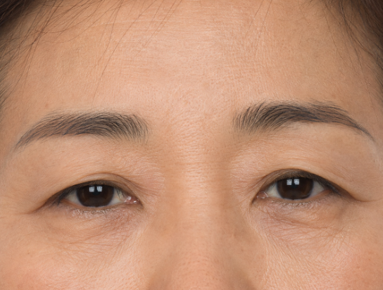 What's the Difference Between Upper Blepharoplasty and Double Eyelid Surgery for People in Their 50s? 사진 3
