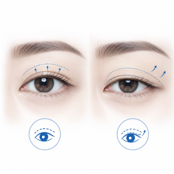 What's the Difference Between Upper Blepharoplasty and Double Eyelid Surgery for People in Their 50s? 사진 6
