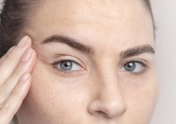 Lower Blepharoplasty for Those in Their 50s: Is Removing Only Under-Eye Fat Enough? 사진 6