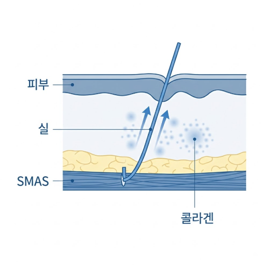 Gangnam Thread Lift Guide: Making an Unregrettable Choice for a Thread Lift 사진 3