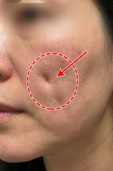 Aptos Thread Lift: How Does It Differ from General Thread Lifts? 사진 9