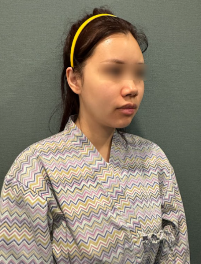 Looking for a good thread lift clinic in Seoul? A comprehensive guide to thread lift types and features 사진 9