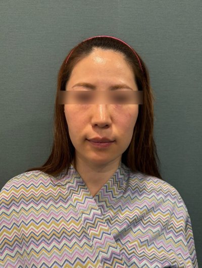 Gangnam Thread Lift Duration: Can it Last Over a Year? 사진 7
