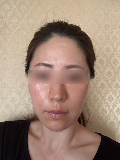 Gangnam Thread Lift Duration: Can it Last Over a Year? 사진 8